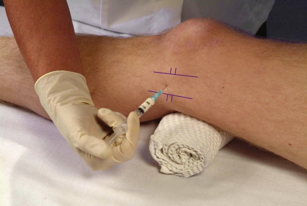 Cauzele excesului de lichid în articulația genunchiului, simptome și tratament - Dermatită November