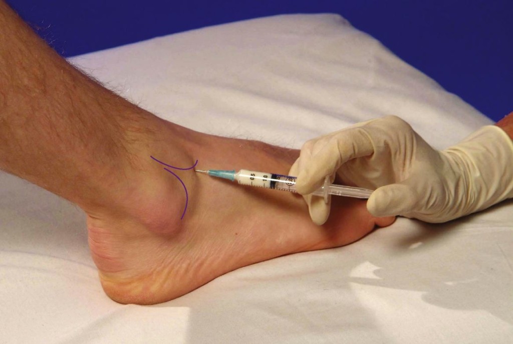 Cum se tratează lichidul în articulația gleznei Recenzii de genunchi de injecție de gel