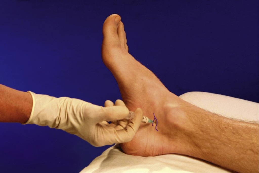 Tehnica de injectare a medicamentului în articulația genunchiului