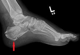 osteoartrita calcaneului terapia osteoartritei genunchiului