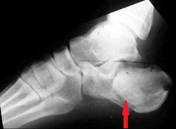 umflarea articulației după fracturarea călcâiului)