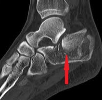 umflarea articulației după fracturarea călcâiului