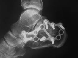 fractură articulară cu fractură de călcâie durere chiar sub articulația gleznei