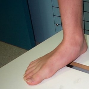 piciorul plat transversal și artroza articulației genunchiului)