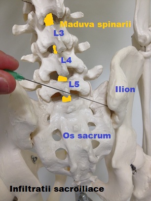 durere la nivelul coloanei vertebrale inferioare tratamentul osteocondrozei cronice a coloanei lombare