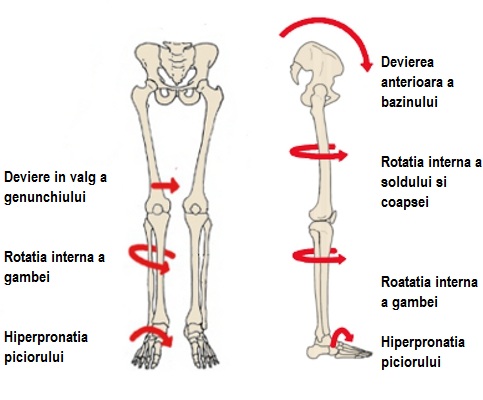 artroza articulației gleznei și a picioarelor plate)