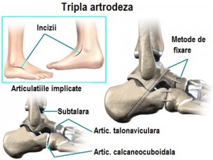 piciorul plat și artroza genunchiului