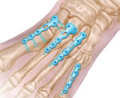 tratamentul sternului artrozei claviculare lichid în medicamentele articulației genunchiului