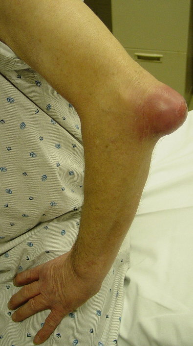 deteriorarea articulației umărului drept simptomele și tratamentul artritei în brațe