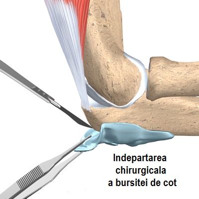 Bursita de Cot (Olecraniană) Tratament standard pentru bursita articulației cotului