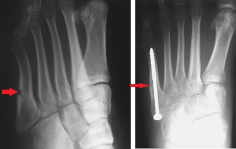 artroza și artrita articulațiilor mici ale piciorului