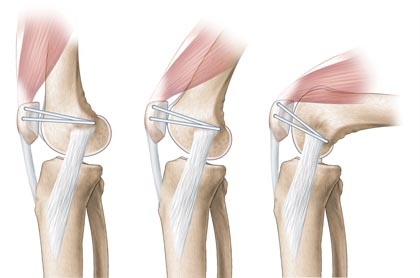 The Effectiveness of Open Repair Versus Percutaneous Repair for an Acute Achilles Tendon Rupture