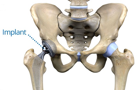 articulație de șold drept dureri la genunchi la ridicarea piciorului