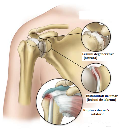 leziuni ale ligamentului claviculei articulației umărului)