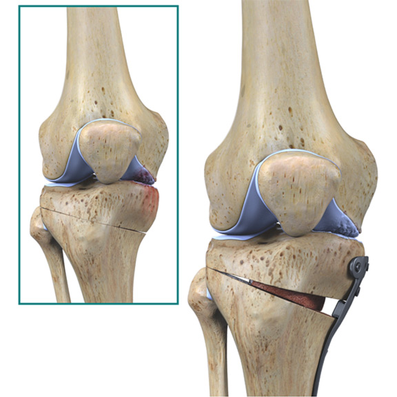 adult-knee-tibial-osteotomy-opening-wedge