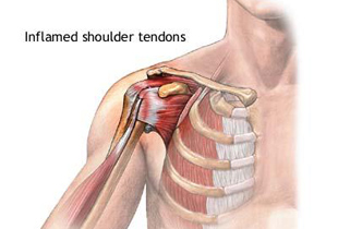 ruperea tendonului mușchiului supraspinatus al tratamentului articulațiilor umărului)