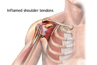 Durerile Umarului – Cauze si tratament