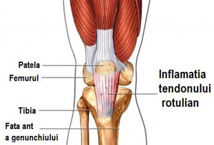 cum să tratezi inflamația tendoanelor genunchiului)
