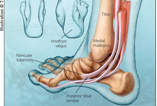 cum se tratează teninoza gleznei durere și clicuri în articulația genunchiului