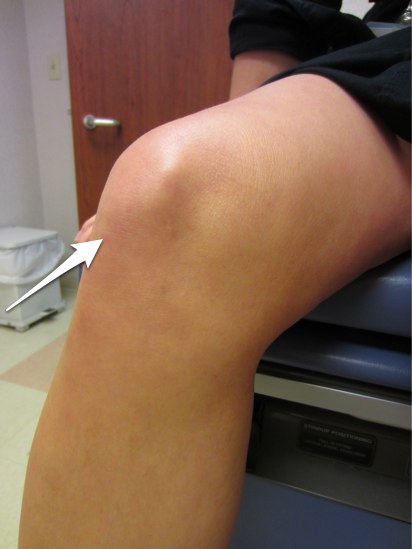 semne ale artritei simptomelor și tratamentului articulației genunchiului dureri articulare cu adnexită