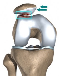 Tratamentul artrozei umărului genunchiului. Artroza umărului descrisă de dr. Gabriel Ștefănescu