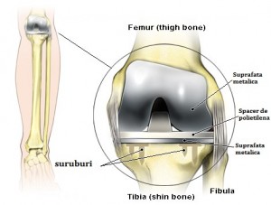 Total-Knee-Replacement