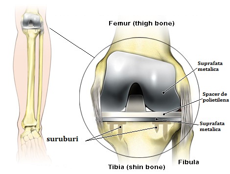 Gonartroza 3 grade ale tratamentului articulației genunchiului