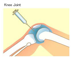 ruptură de menisc exerciții pentru artroza tratamentului articulației genunchiului