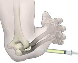 dureri la nivelul genunchiului peste genunchi dislocarea gleznei