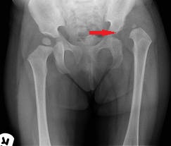 luxarea congenitală a articulației șoldului doare artrita reumatoida (boala inflamatorie articulara)