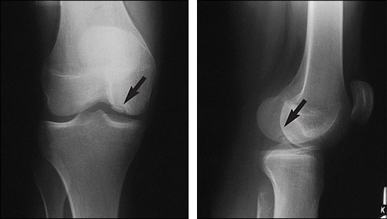 osteochondrita simptomelor și tratamentului genunchiului timp de tratare a entorsei gleznei