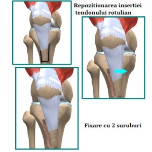 artroza femoropatelară a genunchiului
