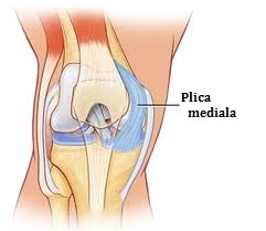 Sindromul pliului mediopatelar al tratamentului articulației genunchiului