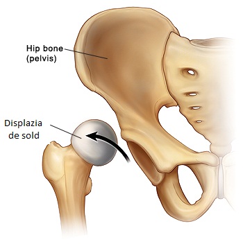 Tratamentul luxației cronice a articulației șoldului Articulația artificială a genunchiului este