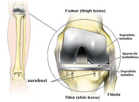 când durerea apare după artroplastia genunchiului)