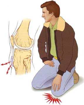 bursită pentru dureri de genunchi