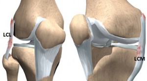 deteriorarea parțială a ligamentului lateral medial al genunchiului artroza în tratamentul gâtului