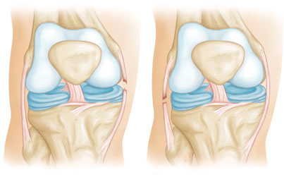 Ligamentita tratamentului articulației genunchiului
