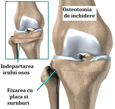 Rănirea tibiei la genunchi - Artroza articulației interfalangiene