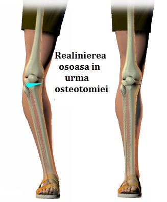 rănirea tibiei la genunchi tratamentul artrozei piciorului 2 grade