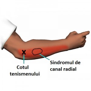 Tratamentul unui nerv strâns în articulația cotului
