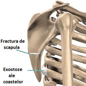 Sindromul de snapping scapula