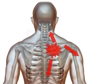 durere ascuțită între omoplați în apropierea coloanei vertebrale