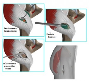 falsă bursită a tratamentului detașării mușchiului articulației umărului