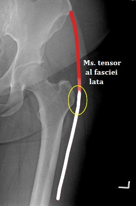 articulația șoldului durere de trohanter mai mare gel unguent pentru osteoartrita