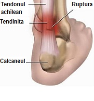 Tendinita: simptome, prevenţie şi tratament