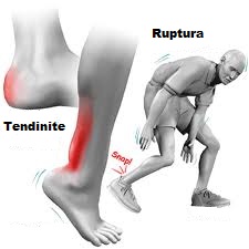 Dureri la tendonul lui Achile - afecțiuni posibile și tratament