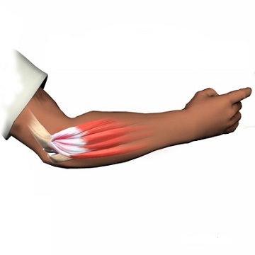 Epicondilita laterală (tennis elbow)