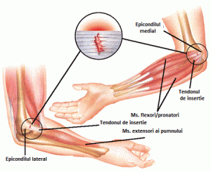 durere constantă în articulația cotului crâșnituri și dureri articulare