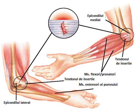 deteriorarea nervului radial al articulației cotului)
